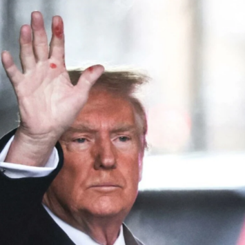 Trump Responds To Questions About His Hand